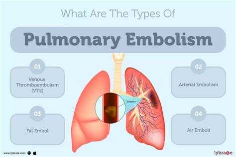 Pulmonary Embolism Treatment