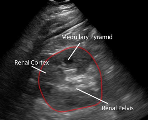 Kidney Ultrasound Images Normal