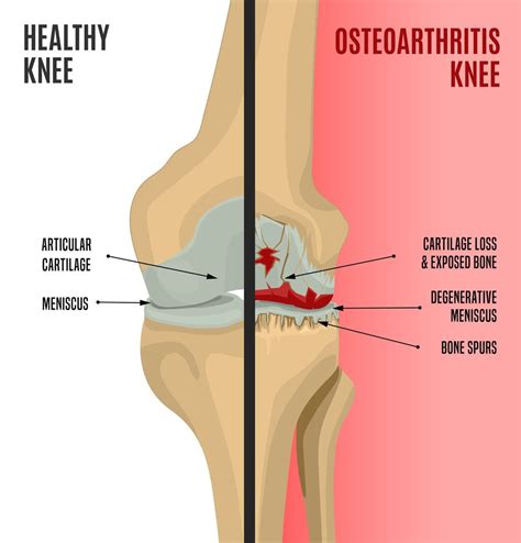 Osteoarthritis Knee Pain: Get Relief from GAE - Precision Vascular