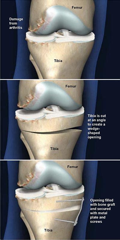 Tibial Osteotomy with Open Wedge | Central Coast Orthopedic Medical Group