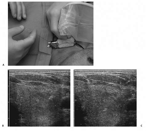 Fine-Needle Aspiration Biopsy of Thyroid Nodules | Radiology Key