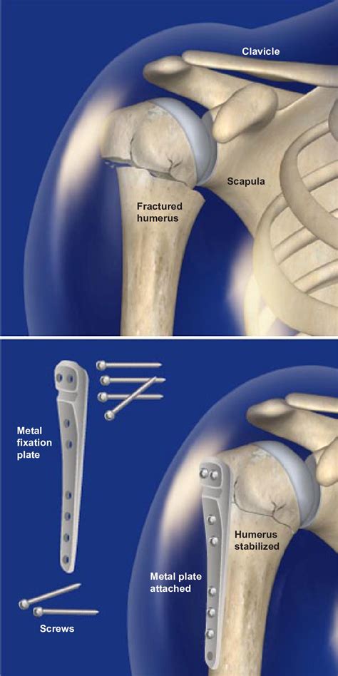 How Proximal Humerus Fractures Are Treated Humerus Fracture Rotator | My XXX Hot Girl