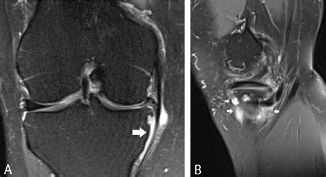 Pes anserinus bursa. Coronal FS T2-WI (A) and sagittal FS T2-WI (B ...