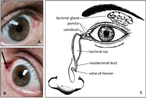 A Novel Treatment for Nasolacrimal Air Regurgitation Into the Eye With CPAP: The Total Face Mask ...