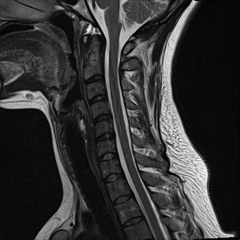 Normal trauma cervical spine MRI | Image | Radiopaedia.org