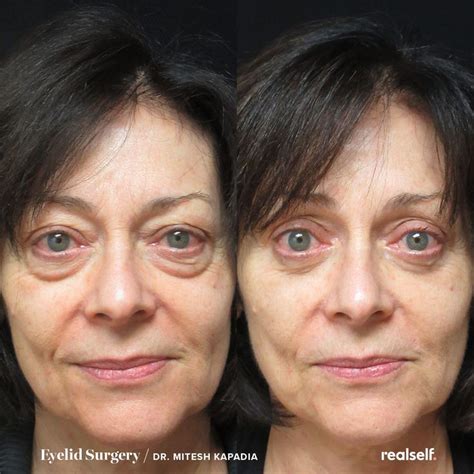 From eyelid surgery to breast augmentation Eye Bag Surgery, Eyelid Surgery, Eye Bags Treatment ...