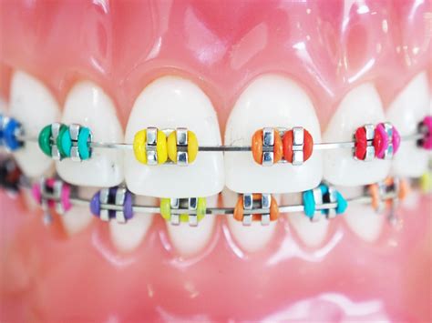 What Braces' Color Are Used For? - Orthodontic Services