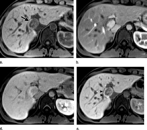 Liver Adenoma Mri | Hot Sex Picture