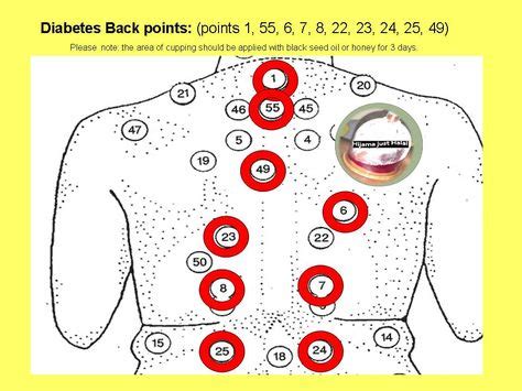 58 HIJAMA POINTS ideas in 2021 | hijama, hijama points, cupping therapy