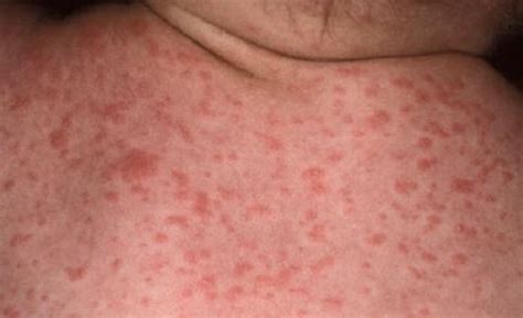 Lamictal rash – Symptoms, Treatment, Images | HubPages