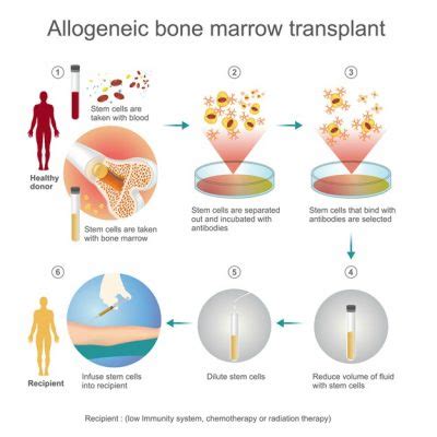 Stem Cell Transplants: What To Know About This Life-Saving Procedure