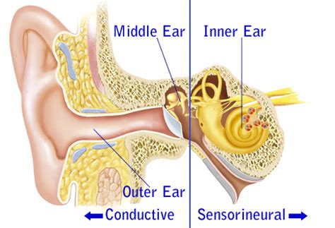 Sensorineural Hearing Loss