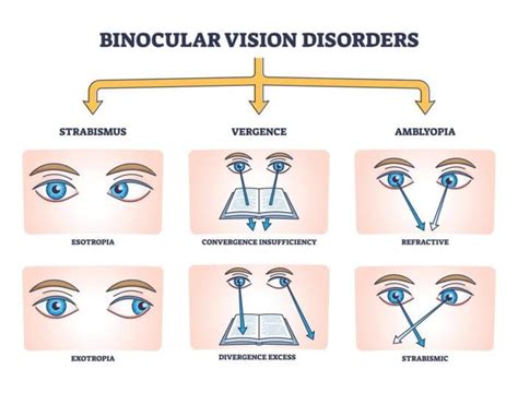 Convergence Insufficiency: Causes, Symptoms and Treatments