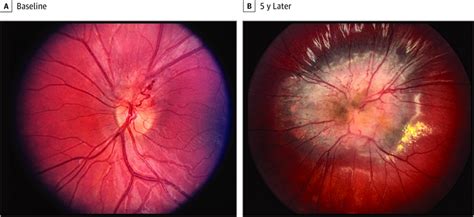 Evolution of a Peripapillary Combined Hamartoma of the Retina and Retinal Pigment Epithelium in ...