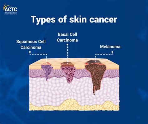 4 Effective Ways to Prevent Skin Cancer | ACTC Blogs