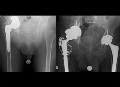 Innovative Hip Revision Surgery Technique Brings Relief