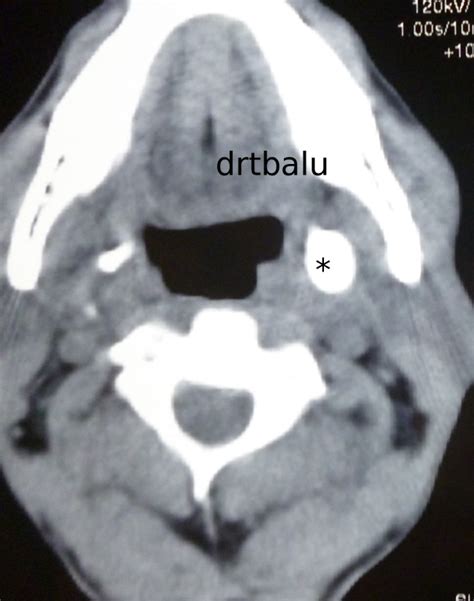 Styloid process syndrome - Drtbalu's otolaryngology case record