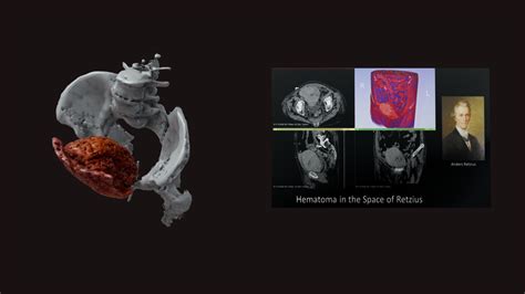 Hematoma in the Space of Retzius - Download Free 3D model by tl0615 ...