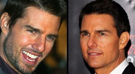 Tom Cruise before and after plastic surgery 02 – Celebrity plastic ...