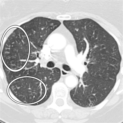 Bronchiolitis: A Practical Approach for the General Radiologist | RadioGraphics