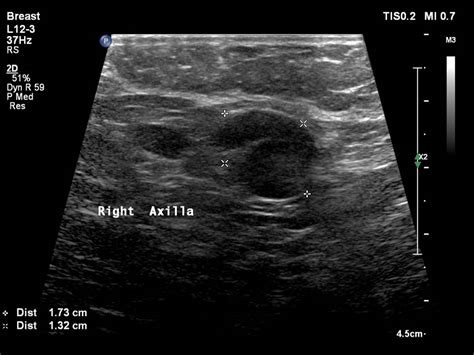 Atlas of breast cancer early detection