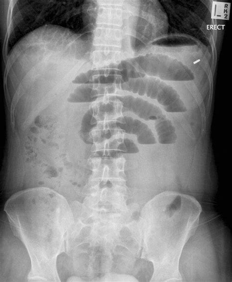 AXR Interpretation • LITFL • CCC Investigations