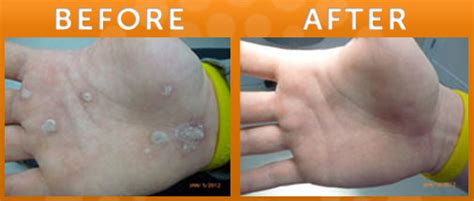 Laser Treatment for Warts in New Jersey | SOMA Skin & Laser