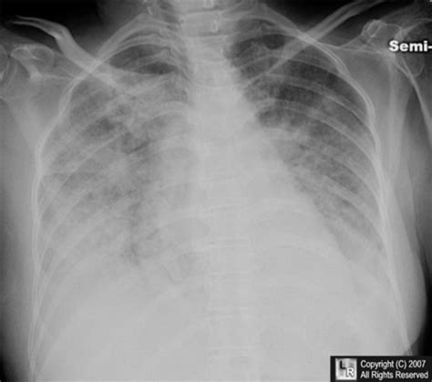 Learning Radiology - Congestive Heart Failure, Pulmonary Edema