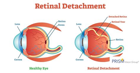 What Is a Detached Retina? - The Eye Care & Surgery Center