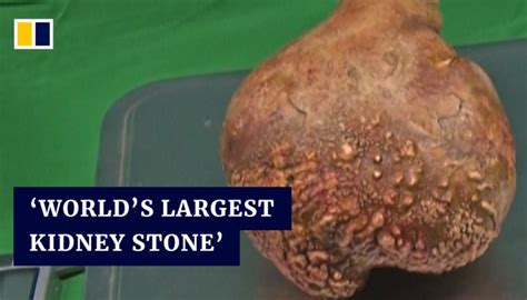 Sri Lankan army doctors remove world's largest kidney stone, setting world record | South China ...