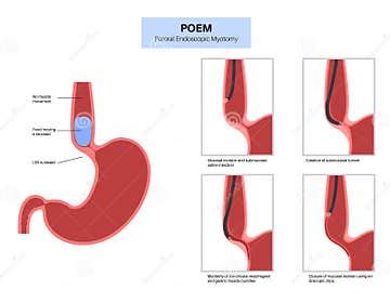 POEM medical poster stock illustration. Illustration of gastroesophageal - 290376552