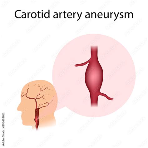 Carotid artery aneurysm. Widening of the vessel. Medical illustration. Stock Illustration ...