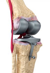 Did Your Zimmer Persona Knee Implant Fail or Loosen?