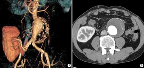 Figure 1:Abdominal Aortic Aneurysm Repair in Patient with a Renal ...