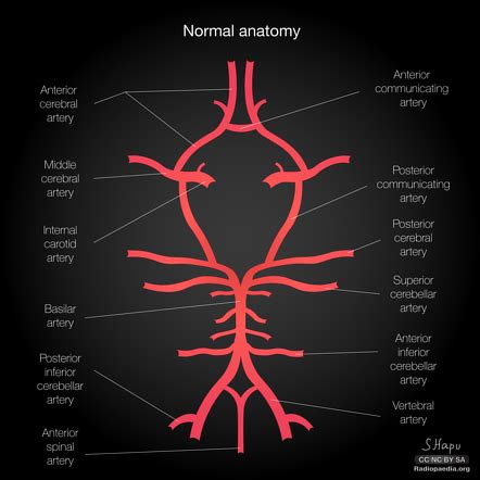 Basilar artery | Radiology Reference Article | Radiopaedia.org