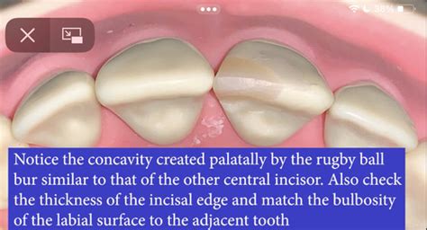 Fractured incisal edge composite- finishing polishing Flashcards | Quizlet