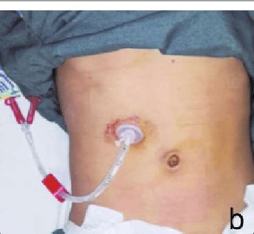 a: Endoscopic view, showing PEG tube in stomach. b: PEG tube placed on... | Download Scientific ...