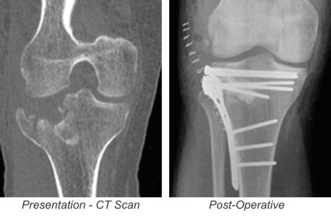 Tibia Schatzker Type II Fracture Treatment | Biocomposites