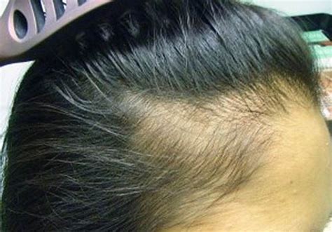 Scalp Infections That Cause Hair Loss | Hair Transplant Dubai