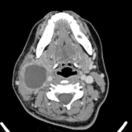 Second branchial cleft cyst | Radiology Case | Radiopaedia.org