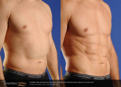 SmartLipo Laser Lipolysis - Lindon UT