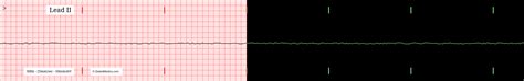 The Asystolic EKG/ECG