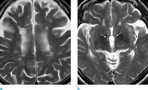 The Fornix: Functional Anatomy, Normal Neuroimaging, and Various ...