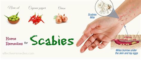 Top 20 Natural Home Remedies For Scabies Treatment In Humans