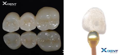 EMAX CROWN AND ZIRCONIA CROWN- WHICH ONE IS BETTER? - Xdent Center