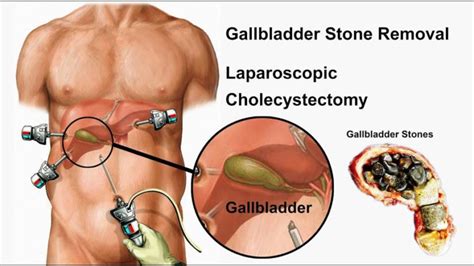 Laparoscopic treatment to Remove Gallstone in Hyderabad - Harcourt Health