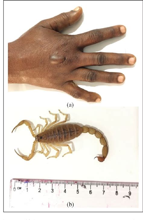 Scorpion Stinger Anatomy