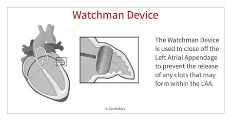 What is the Watchman Device and How Does it Work? Cardioserv