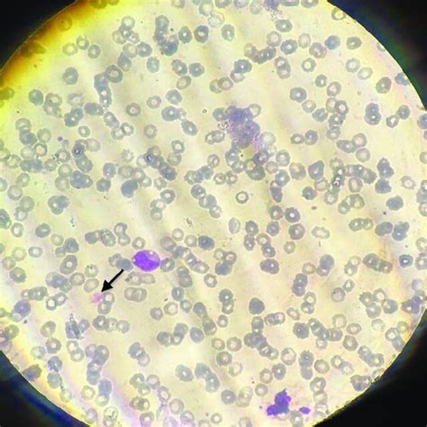 Peripheral blood smear, thin region (Giemsa stain, x1000... | Download Scientific Diagram