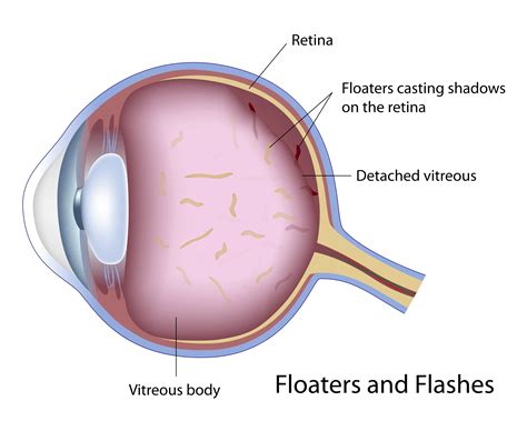 Eye Vitreous Floaters | Petrou Eye Care